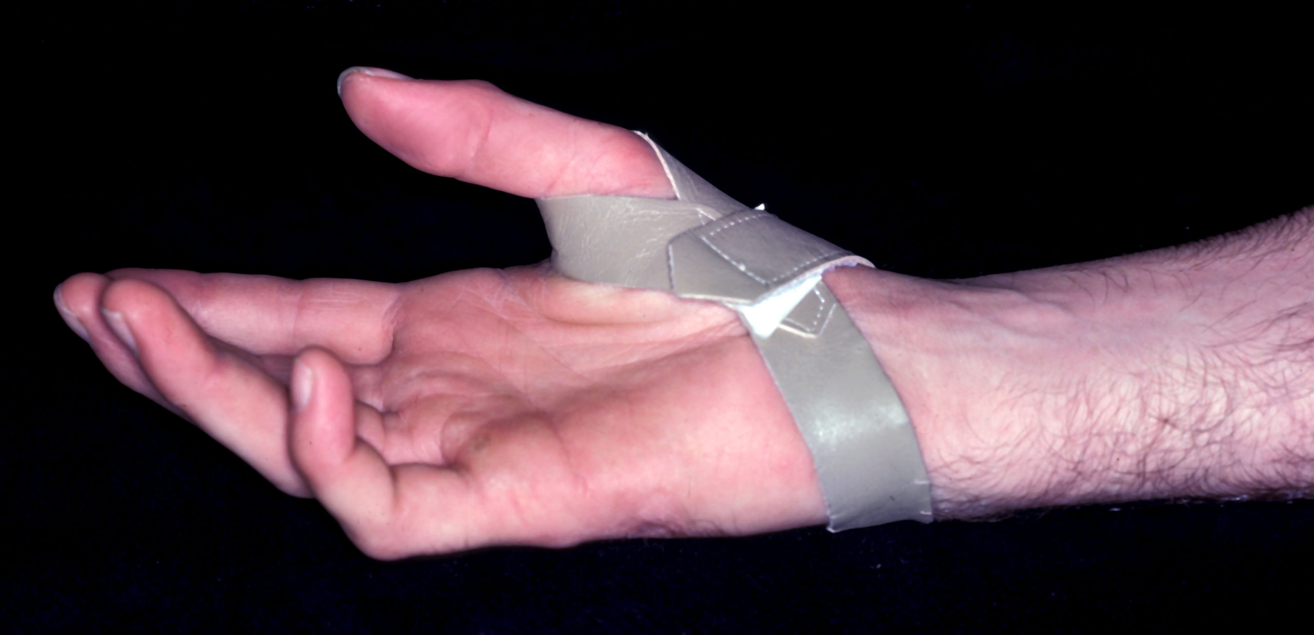 Splinting the Hand with a Peripheral Nerve Injury