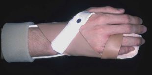 Leather straps are used with other strapping materials in a splint for long term wear following excision of a malignancy and full thickness graft on the palmar aspect of the ring and little fingers.