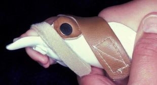 Leather straps are used to secure a young child’s hand in a splint to reduce the PIP joint flexion contracture resulting from camptodactyly.